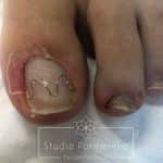 Nagelbeugel in Purmerend