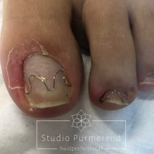Nagelbeugel in Purmerend