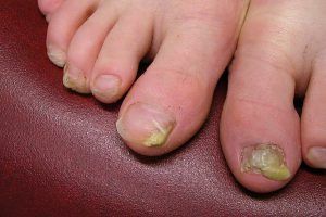 Schimmelnagels Purmerend