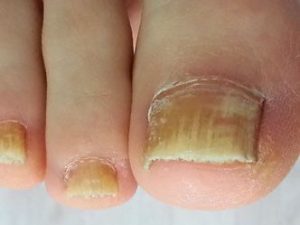 Pedicure Mycose nagels