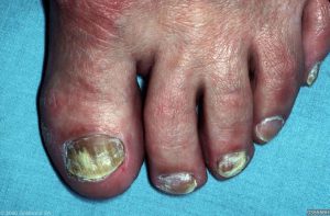 Pedicure behandeling schimmelnagels Purmerend