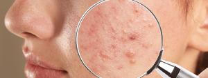 Acne vulgaris