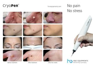Cryopen Studio Purmerend